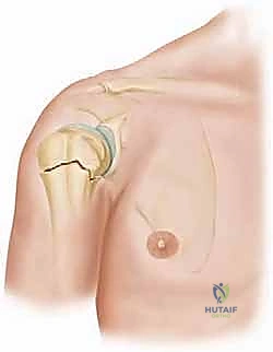خيارات العلاج التحفظي والجراحي لكسور الكتف