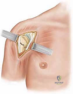 استخدام التقنيات الحديثة في تثبيت كسور الكتف