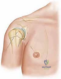 أعراض وعلامات كسور الكتف عند الأطفال