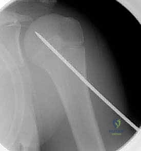 تشريح مفصل الكتف المعقد عند الأطفال ومراكز النمو