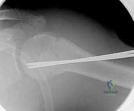 تصنيف كسور عظمة الترقوة والعضد عند الأطفال