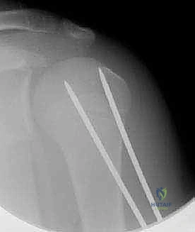 صورة توضيحية لـ كسور كتف الأطفال: دليل شامل للعلاج والرعاية المتخصصة مع الأستاذ الدكتور محمد هطيف