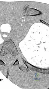 التشخيص الإشعاعي الدقيق لكسور كتف الأطفال