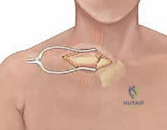 صورة توضيحية لـ كسور كتف الأطفال: دليل شامل للعلاج والرعاية المتخصصة مع الأستاذ الدكتور محمد هطيف