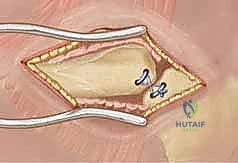 صورة توضيحية لـ كسور كتف الأطفال: دليل شامل للعلاج والرعاية المتخصصة مع الأستاذ الدكتور محمد هطيف