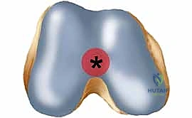 تشخيص كسور الفخذ بالأشعة