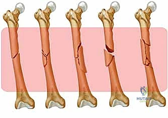 صورة طبية: تثبيت كسر عظم الفخذ بالمسامير الارتدادية: دليل شامل للمرضى في صنعاء مع الأستاذ الدكتور محمد هطيف