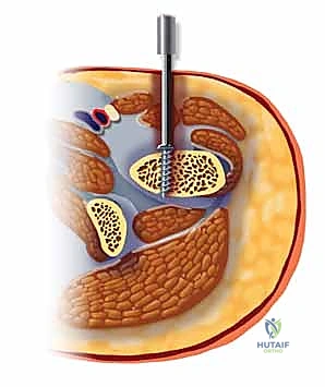 صورة توضيحية لـ تثبيت كسر عظم الفخذ بالمسامير الارتدادية: دليل شامل للمرضى في صنعاء مع الأستاذ الدكتور محمد هطيف
