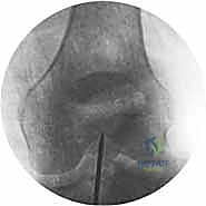 صورة توضيحية لـ تثبيت كسر عظم الفخذ بالمسامير الارتدادية: دليل شامل للمرضى في صنعاء مع الأستاذ الدكتور محمد هطيف
