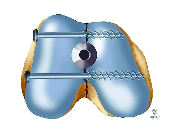 صورة طبية: تثبيت كسر عظم الفخذ بالمسامير الارتدادية: دليل شامل للمرضى في صنعاء مع الأستاذ الدكتور محمد هطيف