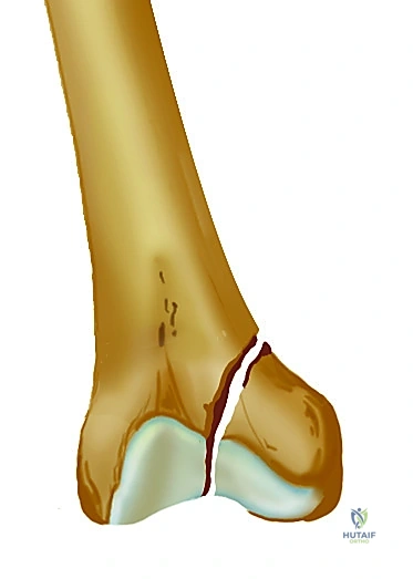 صورة طبية: تثبيت كسر عظم الفخذ بالمسامير الارتدادية: دليل شامل للمرضى في صنعاء مع الأستاذ الدكتور محمد هطيف