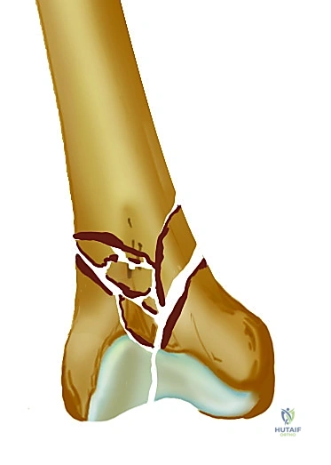 صورة طبية: تثبيت كسر عظم الفخذ بالمسامير الارتدادية: دليل شامل للمرضى في صنعاء مع الأستاذ الدكتور محمد هطيف