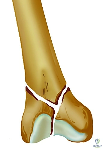 صورة توضيحية لـ تثبيت كسر عظم الفخذ بالمسامير الارتدادية: دليل شامل للمرضى في صنعاء مع الأستاذ الدكتور محمد هطيف