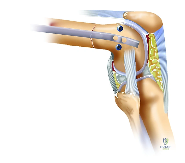 صورة طبية: تثبيت كسر عظم الفخذ بالمسامير الارتدادية: دليل شامل للمرضى في صنعاء مع الأستاذ الدكتور محمد هطيف