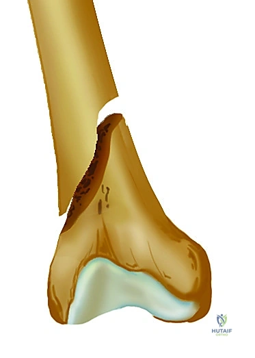 صورة توضيحية لـ تثبيت كسر عظم الفخذ بالمسامير الارتدادية: دليل شامل للمرضى في صنعاء مع الأستاذ الدكتور محمد هطيف