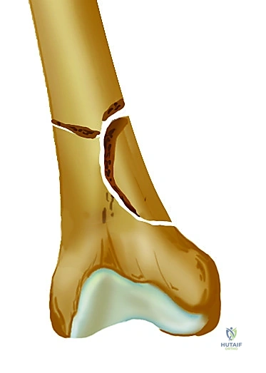 صورة طبية: تثبيت كسر عظم الفخذ بالمسامير الارتدادية: دليل شامل للمرضى في صنعاء مع الأستاذ الدكتور محمد هطيف