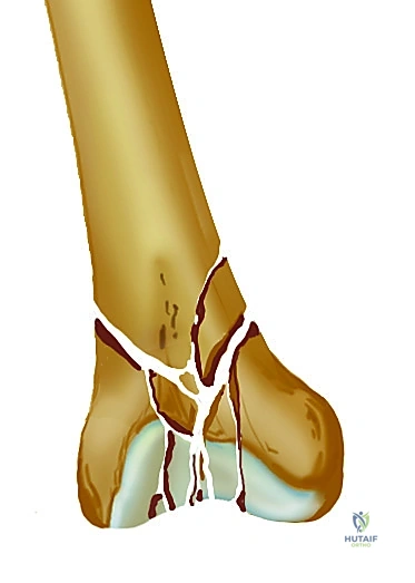 صورة طبية: تثبيت كسر عظم الفخذ بالمسامير الارتدادية: دليل شامل للمرضى في صنعاء مع الأستاذ الدكتور محمد هطيف