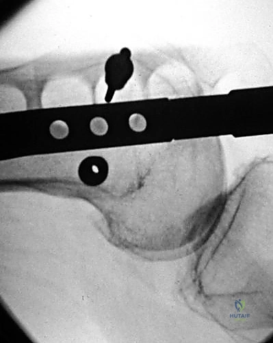 أشعة سينية توضح كسر عظم الفخذ