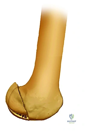 صورة طبية: تثبيت كسر عظم الفخذ بالمسامير الارتدادية: دليل شامل للمرضى في صنعاء مع الأستاذ الدكتور محمد هطيف