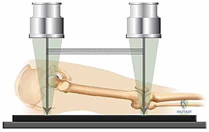 صورة توضيحية لـ تثبيت كسر عظم الفخذ بالمسامير الارتدادية: دليل شامل للمرضى في صنعاء مع الأستاذ الدكتور محمد هطيف