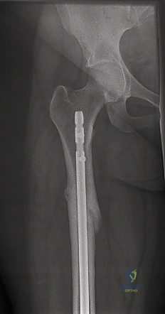 صورة طبية: تثبيت كسر عظم الفخذ بالمسامير الارتدادية: دليل شامل للمرضى في صنعاء مع الأستاذ الدكتور محمد هطيف