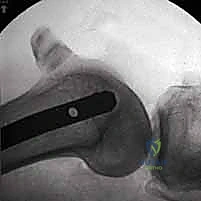 تثبيت كسر عظم الفخذ بالمسامير الارتدادية: دليل شامل للمرضى في صنعاء مع الأستاذ الدكتور محمد هطيف