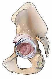 تصنيف فقدان العظم الحقي وتخطيط الجراحة