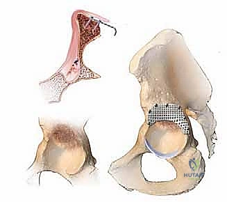 تجهيز الطعم العظمي وبداية عملية الدك