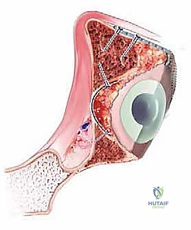 التثبيت النهائي للمفصل الاصطناعي الجديد داخل الحُق المعاد بناؤه