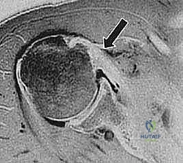 صورة توضيحية لـ إصلاح تمزق العضلة تحت الكتف وتصغير الناتئ الغرابي وتثبيت وتر العضلة ذات الرأسين: دليل شامل للمرضى مع الأستاذ الدكتور محمد هطيف في صنعاء