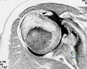 صورة توضيحية لـ إصلاح تمزق العضلة تحت الكتف وتصغير الناتئ الغرابي وتثبيت وتر العضلة ذات الرأسين: دليل شامل للمرضى مع الأستاذ الدكتور محمد هطيف في صنعاء