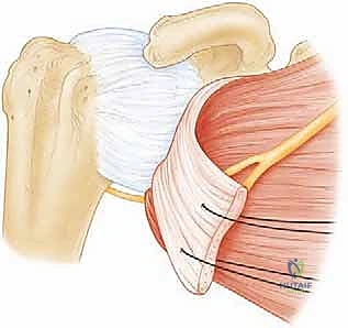 تنظير مفصل الكتف وتقييم الأوتار
