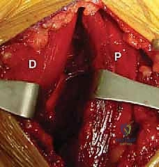 التشخيص الدقيق بالمنظار للانحشار الغرابي