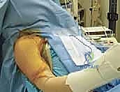 Illustration of subscapularis tendon tears - Dr. Mohammed Hutaif