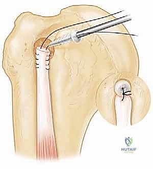 استخدام الخطاطيف الجراحية الدقيقة لتثبيت الوتر