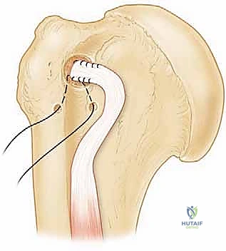 تقييم وتر العضلة ذات الرأسين وتحديد درجة التلف