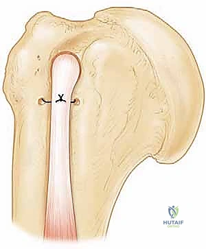 تجهيز الوتر الممزق لعملية الإصلاح