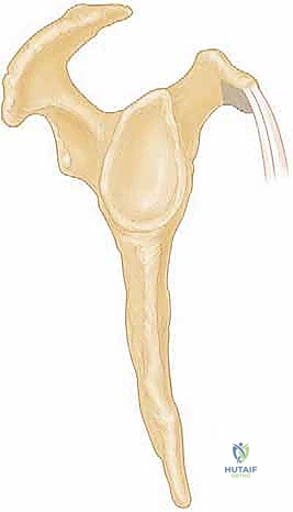 تثبيت وتر العضلة تحت الكتف في مكانه التشريحي