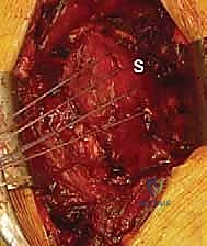 النتيجة النهائية لإصلاح وتر العضلة تحت الكتف