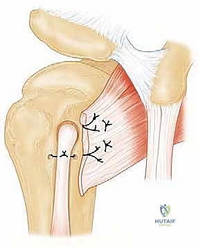إعادة ربط الأوتار باستخدام الخيوط الجراحية المتينة