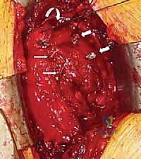 تصغير الناتئ الغرابي لمنع الاحتكاك المستقبلي