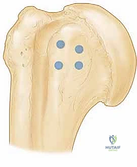 إصلاح تمزق العضلة تحت الكتف وتصغير الناتئ الغرابي وتثبيت وتر العضلة ذات الرأسين: دليل شامل للمرضى مع الأستاذ الدكتور محمد هطيف في صنعاء