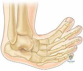 طريقة بونستي لعلاج القدم الحنفاء الخلقية: دليل شامل للمرضى