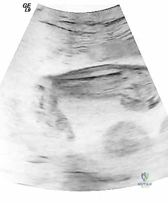 تقييم القدم الحنفاء