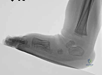 تأثير إهمال العلاج