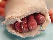 صورة طبية: طريقة بونستي لعلاج القدم الحنفاء الخلقية: دليل شامل للمرضى