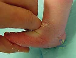 تشوه القدم الحنفاء CAVE