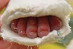 صورة توضيحية لـ طريقة بونستي لعلاج القدم الحنفاء الخلقية: دليل شامل للمرضى