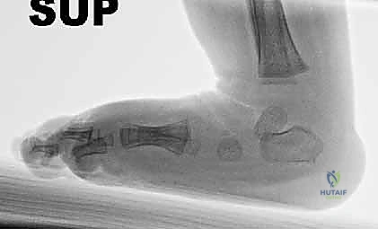 أهمية الالتزام بالدعامة