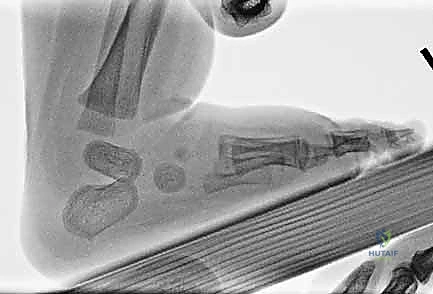 تشريح عظام القدم الحنفاء